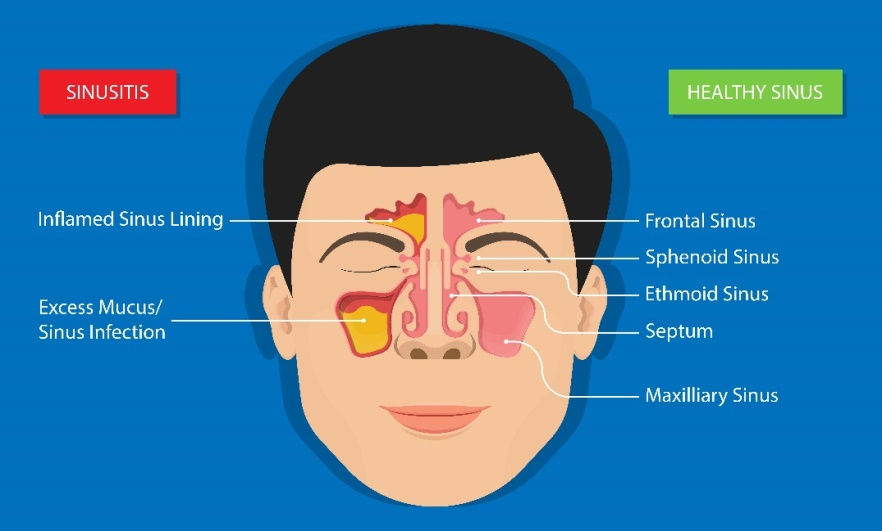Sinusitis? Apakah sama dengan Flu?
